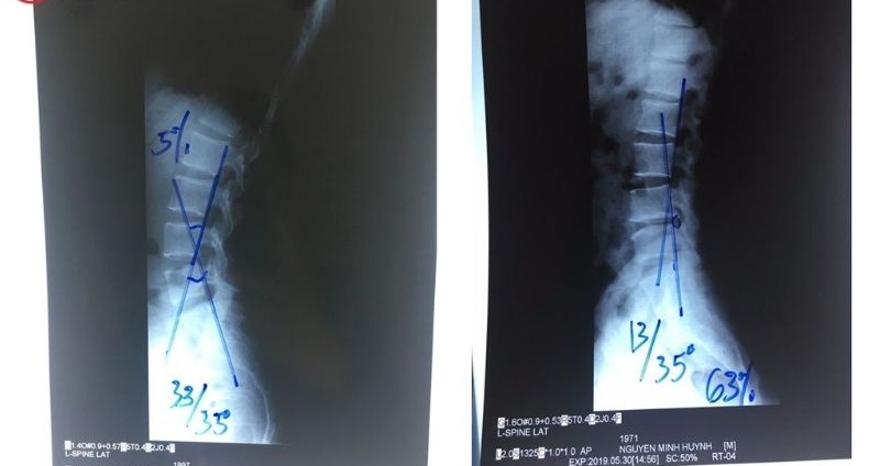 Thoát hóa thắt lưng là gì?