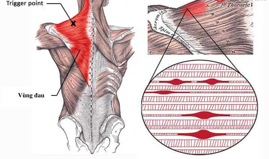 đau và điểm kích hoạt trigger points