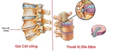 gai xương cột sống