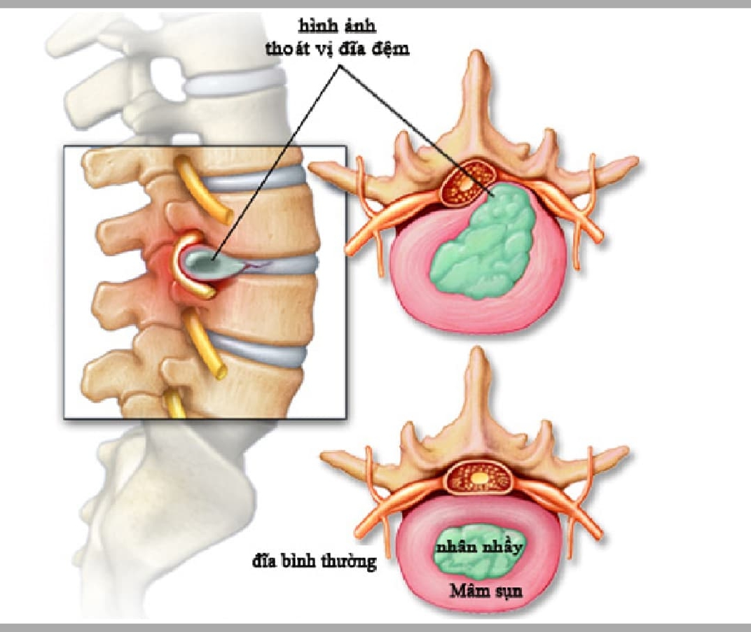 thoát vị đĩa đệm