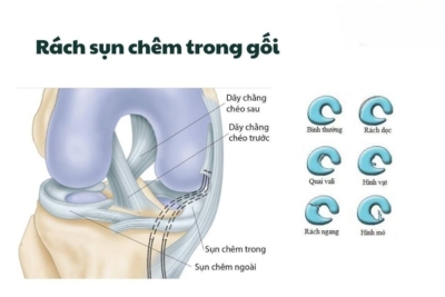 Tổn thương lớp sụn bán nguyệt: