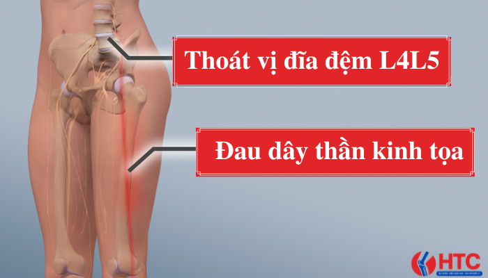 thoát vị đĩa đệm l4l5