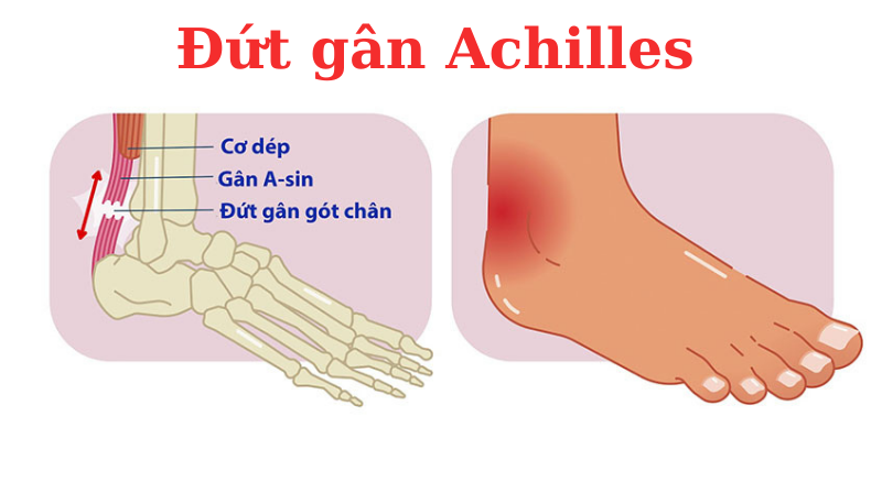 đứt gân achilles