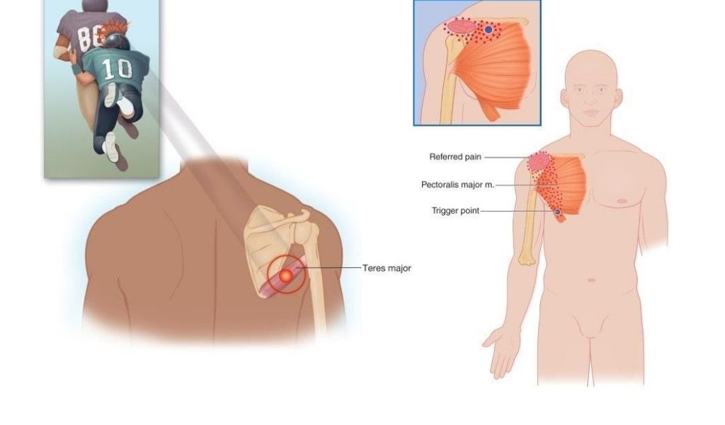 nguyên nhân gây hội chứng cơ tròn lớn