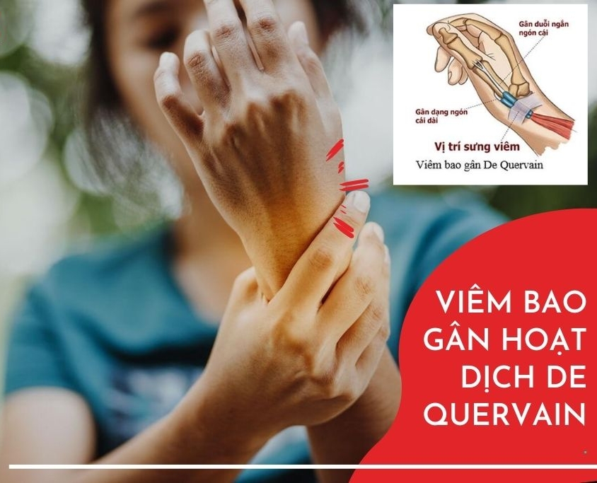 viêm bao gân hoạt dịch de quervain