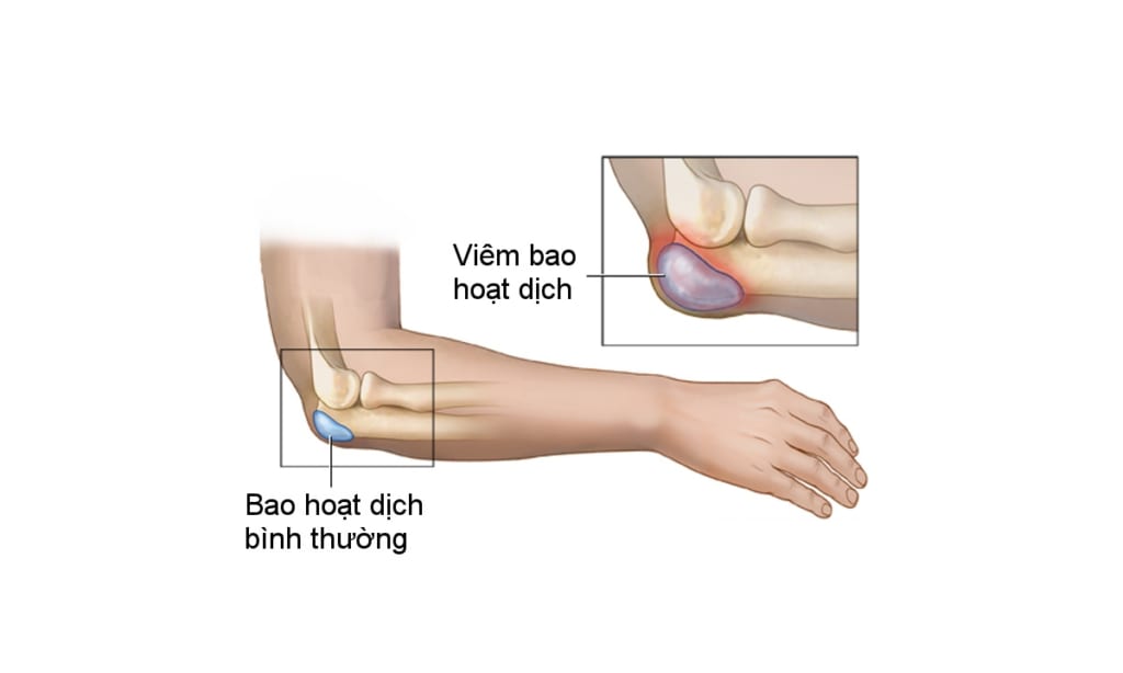 viêm bao hoạt dịch