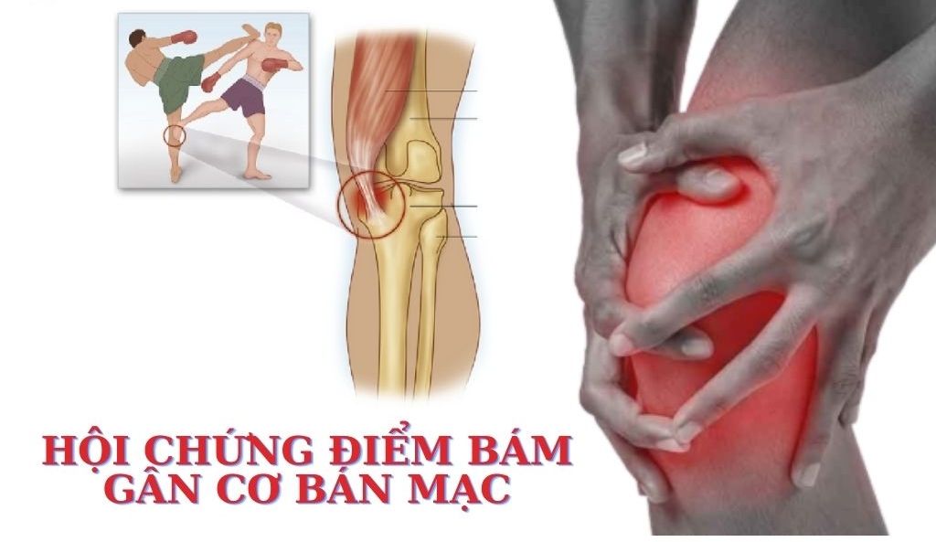 đau điểm bám gân cơ bán mạc