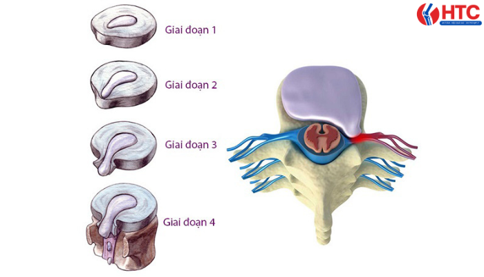 các giai đoạn thoát vị đĩa đệm cổ lưng