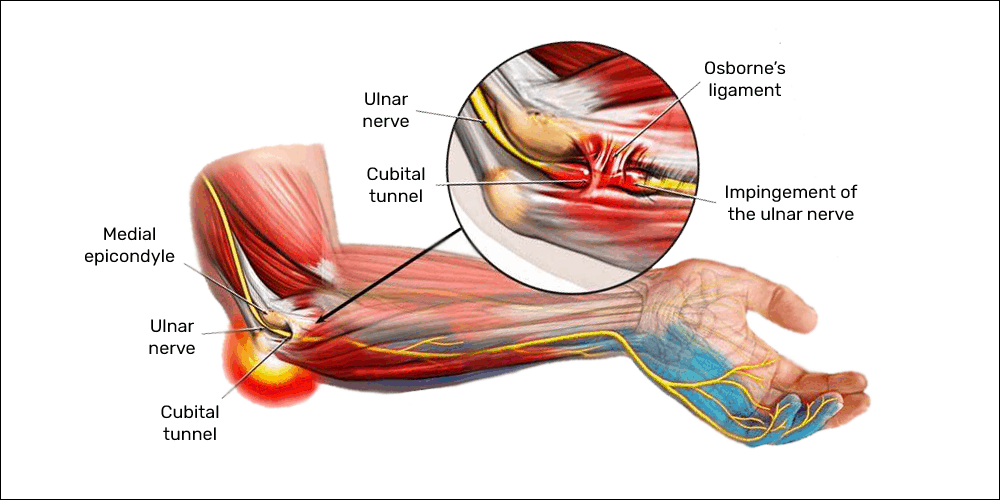 hội chứng đường hầm thần kinh trụ