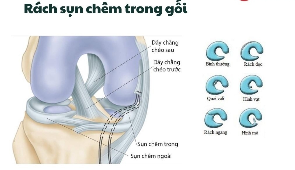 rách sụn chêm trong scc