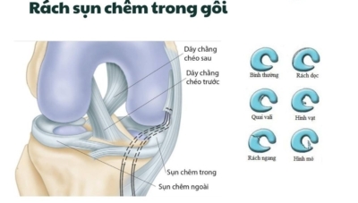 rách sụn chêm trong scc