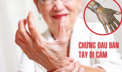 chứng đau bàn tay dị cảm