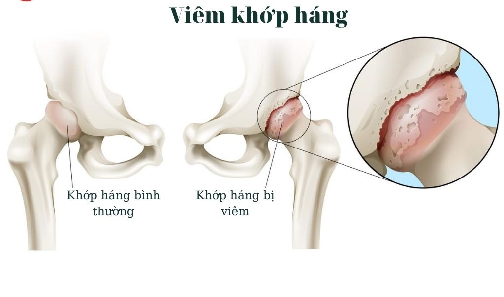 dấu hiệu viêm khớp háng