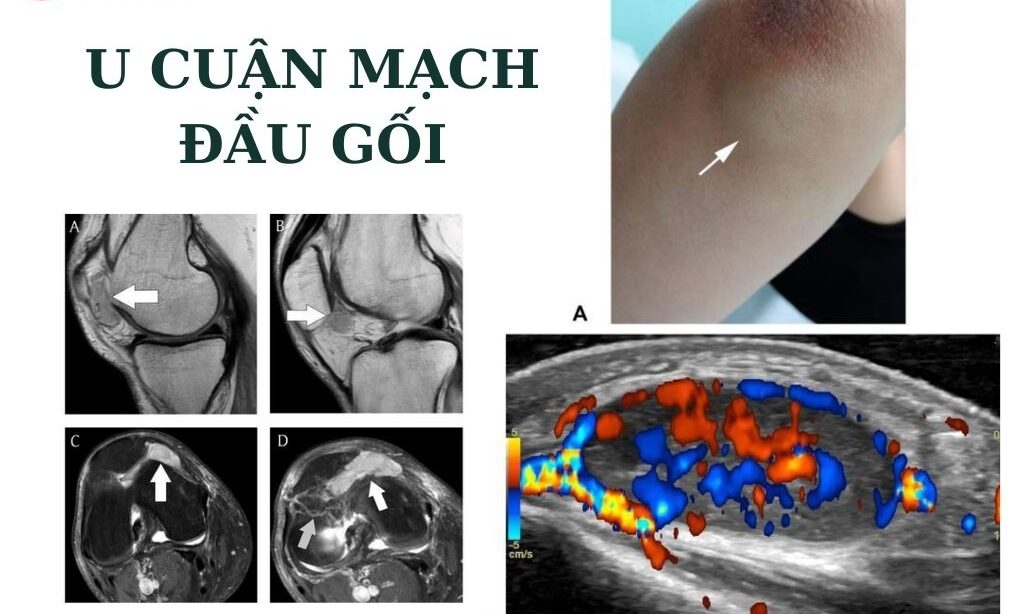 u cuận mạch đầu gối