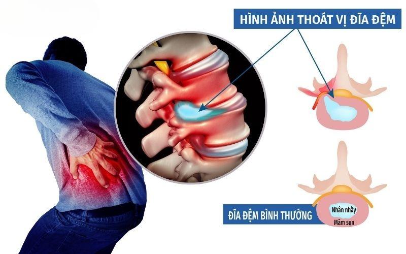 thoát vị đĩa đệm là gì