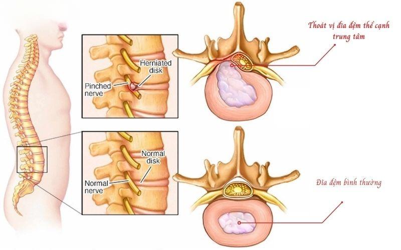 thoát vị đĩa đệm cạnh trung tâm