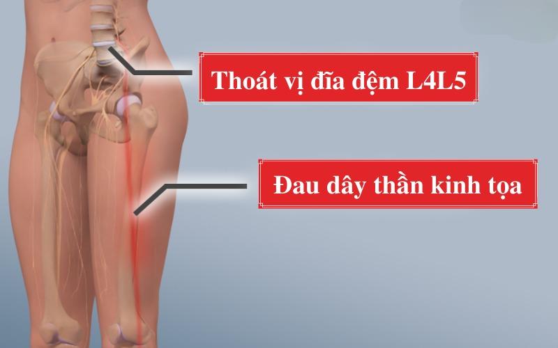 thoát vị đĩa đệm l4l5