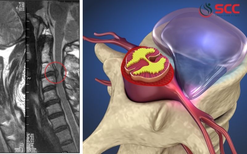 Điều trị thoát vị đĩa đệm C2C3 hiệu quả mà không cần phẫu thuật
