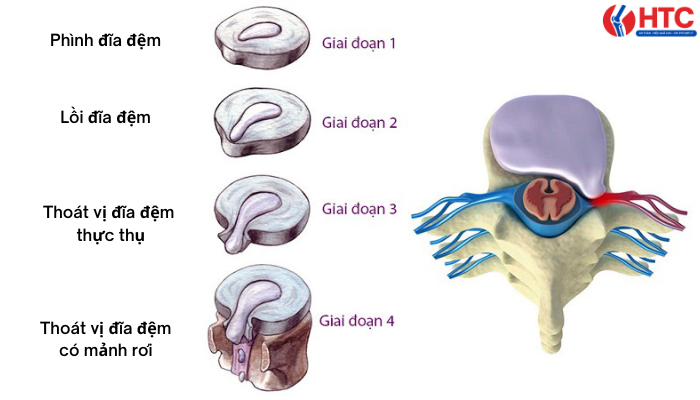 các mức độ thoát vị đĩa đệm