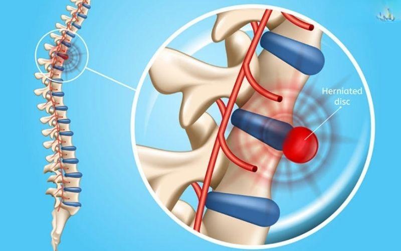 Thoát vị đĩa đệm ngực