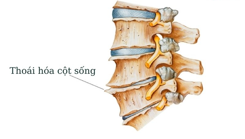 nguyên nhân gây thoát vị nội xốp