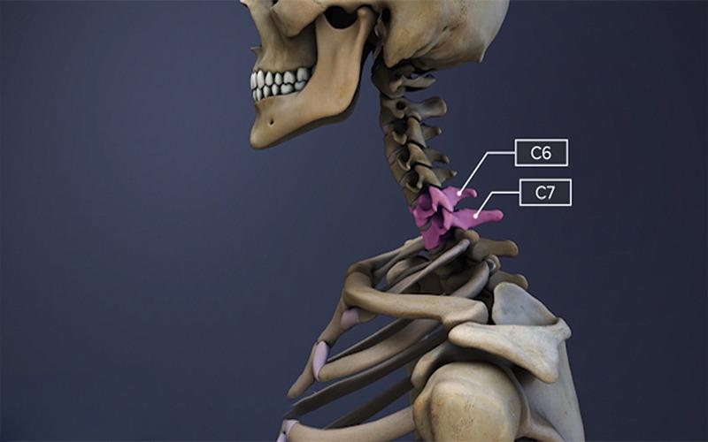 loại thoát vị cổ