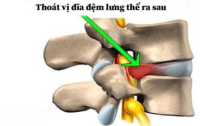 loại thoát vị lưng