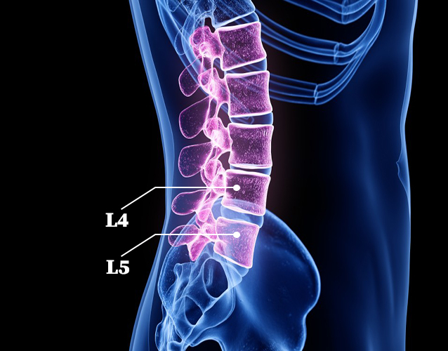 trị thoát vị L4L5