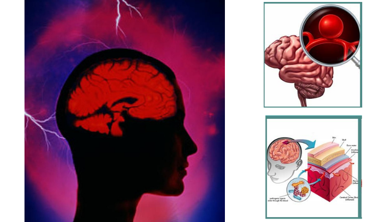 triệu chứng lâm sàng đau đầu kiểu sét đánh nguyên phát