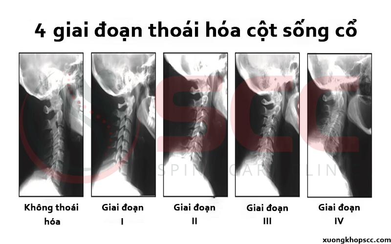 giai đoạn thoái hóa cổ