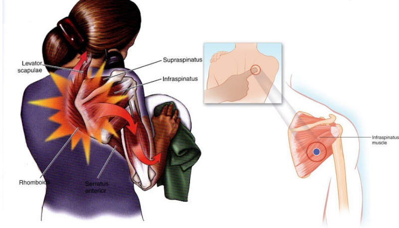 nguyên nhân hội chứng bả vai sườn