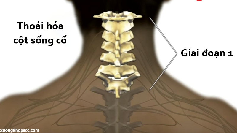 thoái hóa cổ giai đoạn 1