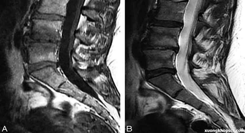thoái hóa lưng giai đoạn 3