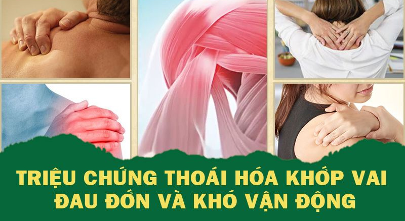 triệu chứng của thoái hóa khớp vai