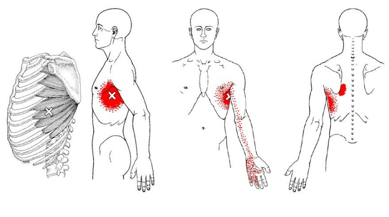 Nguyên nhân gây hội chứng cơ răng trước