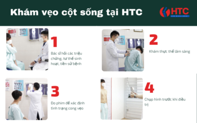 khám cong vẹo cột sống tại htc