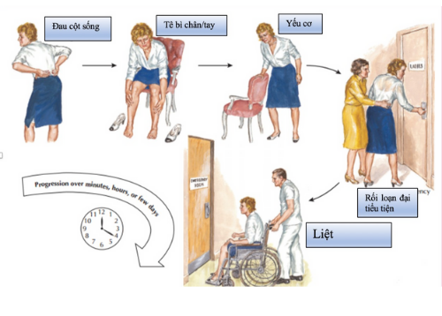 triệu chứng cột sống mất vững