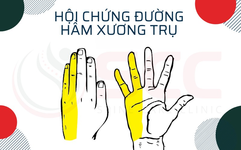 Hội chứng đường hầm xương trụ