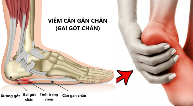 viêm cân gan bàn chân