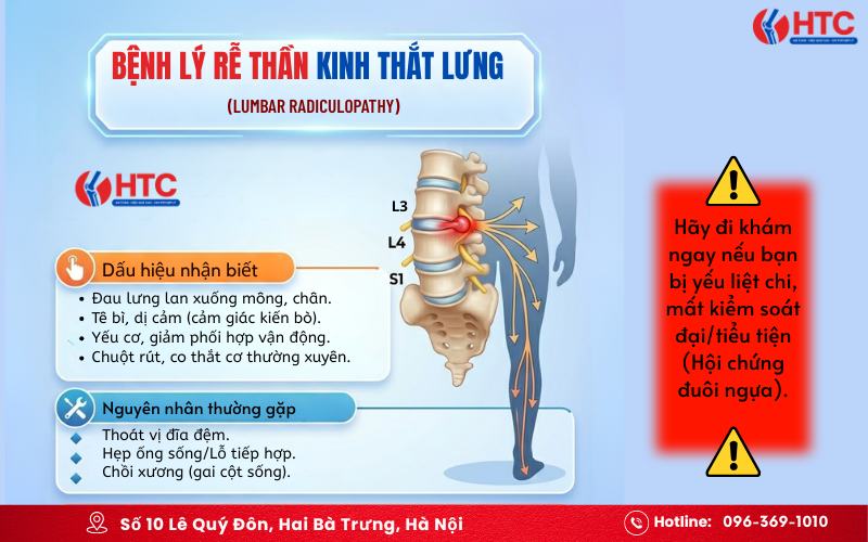 bệnh lý rễ thần kinh thắt lưng