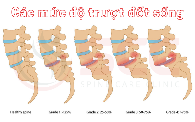 các mức độ trượt đốt sống thắt lưng