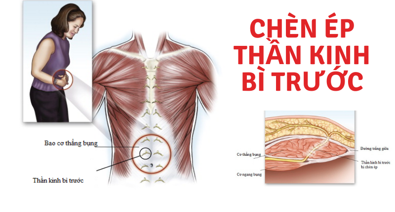 chèn ép thần kinh bì trước