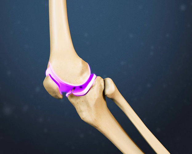 chiropractic chữa thoái hóa khớp gối