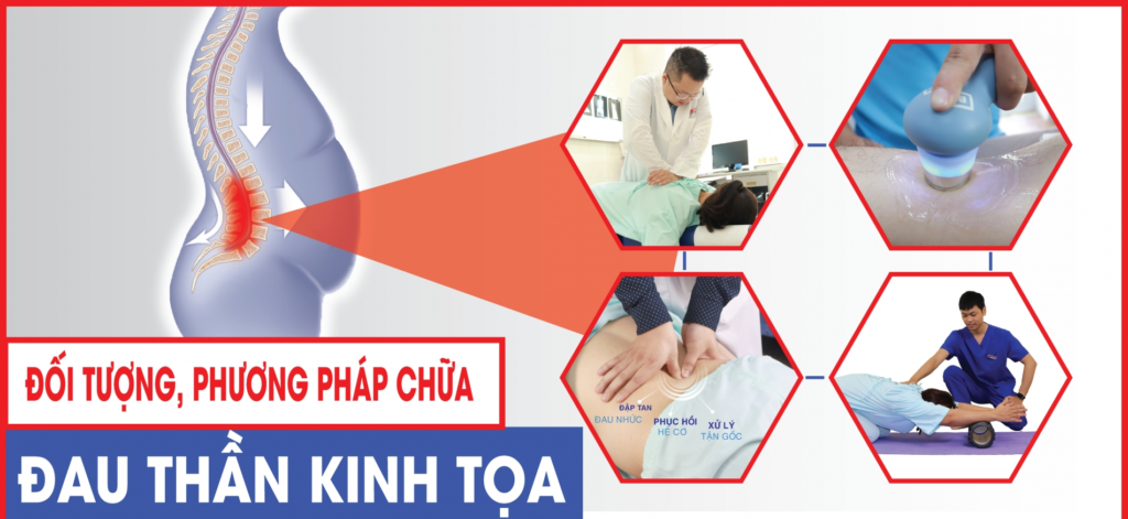 đối tượng và phương pháp chữa đau thần kinh tọa