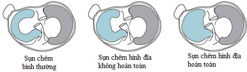 sụn chêm hình đĩa