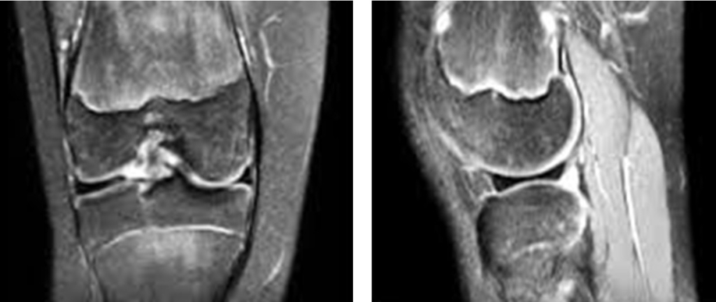 Hình ảnh sụn chêm ngoài hình đĩa trên MRI