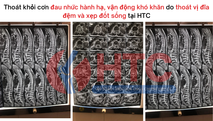 chữa xep đốt sống ở đâu tốt nhất