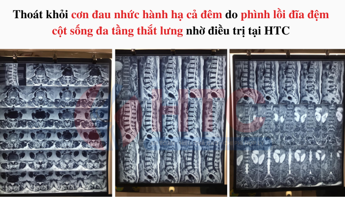 khỏi đau nhức cột sống