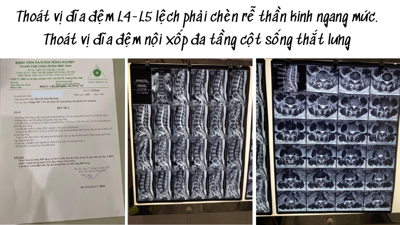 Thoát vị đĩa đệm L4-L5 lệch phải chèn rễ thần kinh ngang mức. Thoát vị đĩa đệm nội xốp đa tầng cột sống thắt lưng