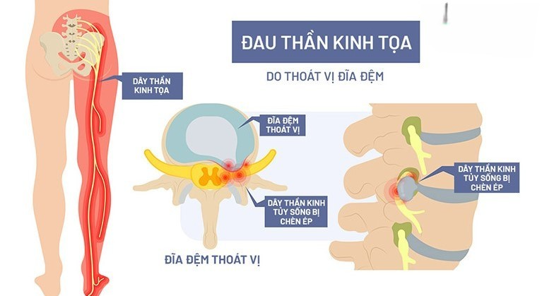 triệu chứng thoát vị đĩa đệm l4 l5